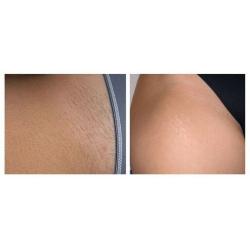 BIKINI HOLLYWOOD PERMANENT LASER HAIR REMOVAL